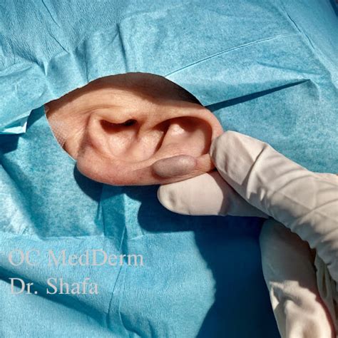 Ear Surgeries Cosmetic Treatment Irvine And Orange County Dermatology
