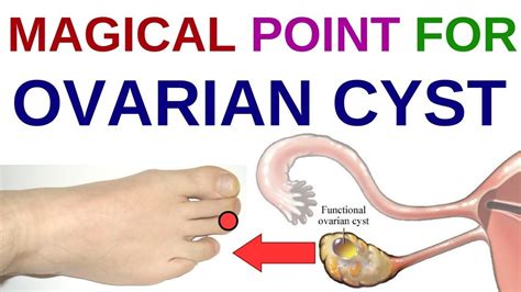 Acupressure Points For Pcos Acupressure Points For Ovary Cyst Acupressure Points For Ovarian