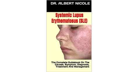 Systemic Lupus Erythematosus Sle The Complete Guidebook On The