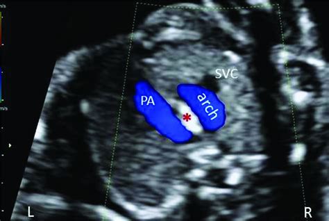 P45 Is It Important To Identify An Isolated Right Aortic Arch In Fetal