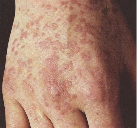 Mehr als 30 typen des humanen papilloma virus (hpv) befallen den genitaltrakt, hauptsächliche auslöser der feigwarzen (auch genitalwarzen. Verruga plantar na mão e pé, sintomas, tratamento e ...