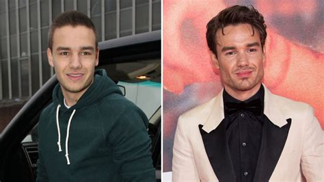Did Liam Payne Get Plastic Surgery Jaw Face Photos