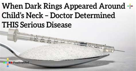 When Dark Rings Appeared Around Childs Neck Doctor Determined This