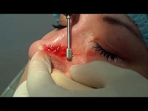 I don't know the size offhand—we have only one. DERMABRASION for scar nose ( use diamond burr ...