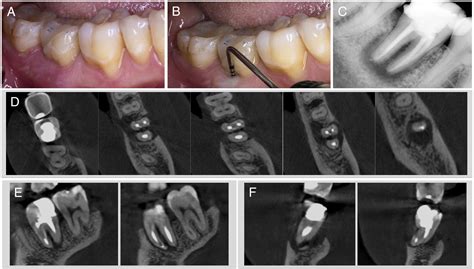 Autotransplantation Of Mandibular Third Molar With Buccal Cortical