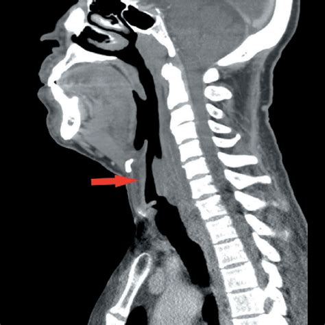 Sagittal View Contrast Enhanced Ct Scan Of The Neck With Download