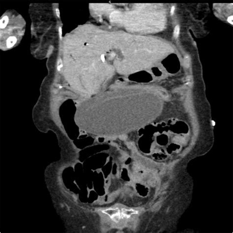 Gallbladder Volvulus A Case Report Radiology And Medical Diagnostic