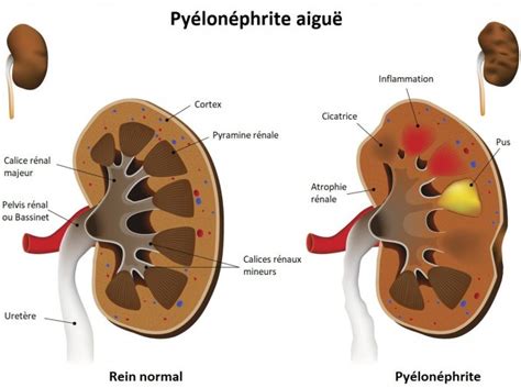 Py Lon Phrite Aigu Infection Du Rein Sympt Mes Causes Traitements