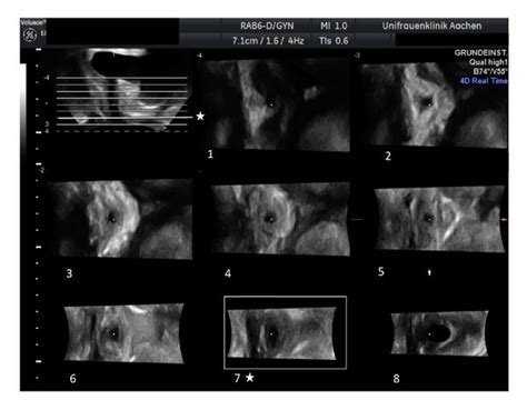 Using Tomographic Ultrasound Imaging Tui 9 Parallel Slices Are