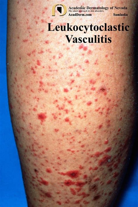 Leukocytoclastic Vasculitis Small Vessel Vasculitis Academic Dermatology Of Nevada