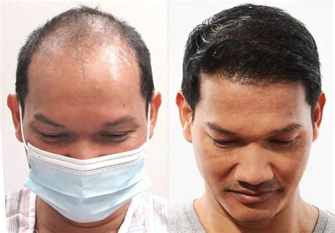 Hair Transplant Before After Results For Men Bosley Hair Transplant