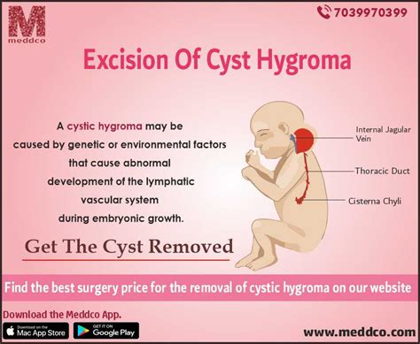 Cystic Hygroma As Related To Edema Pictures
