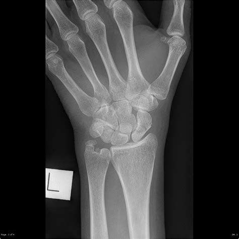 Scaphoid Fracture Image