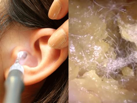 With your head tilted almost parallel to the ground, place the tip of the eyedropper at the edge of the ear canal. VIDEO: Tiny vacuum cleans out earwax - Business Insider