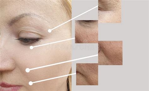 Woman Face Wrinkles Before And After Tension Lifting Correction
