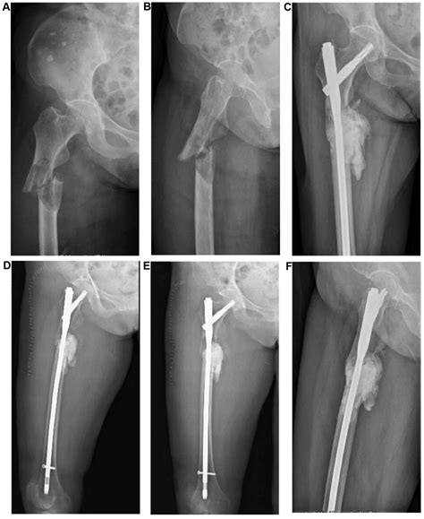 Surgical Management Of Metastatic Lesions Of The Proximal Femur With