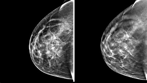 3 D Mammography Finds More Tumors But Questions Remain Health News