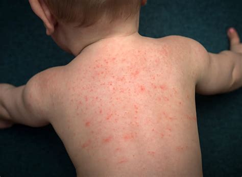 Allergic Reaction Rash On Babies