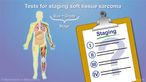 Diagnosing And Treating Soft Tissue Sarcoma