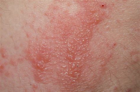 Allergie Manuale Per I Pazienti Dr Nicola Verna La Dermatite Da