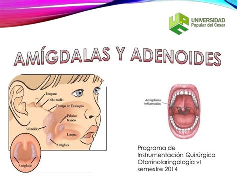 Operacion De Las Amigdalas Y Adenoides En Niños Noticias Niños