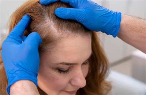 Lupus Hair Loss Reason Why It Happens And How To Stop It
