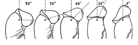 Stretching The Male Meatus