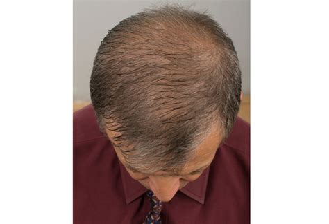 Top More Than 77 Male Balding Hairstyles Vn