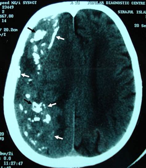 Calcified Chronic Subdural Haematoma Bmj Case Reports
