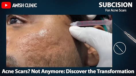 Subcision For Acne Scars Treatment How To Treat Stubborn Acne Scars