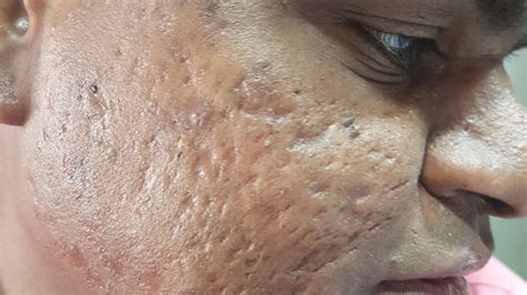 Scar Post Acne Post Chickenpox Or Any Cause Heta Skin Hair Laser