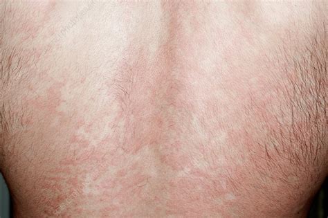 Urticaria Rash On The Back Stock Image C Science Photo Library