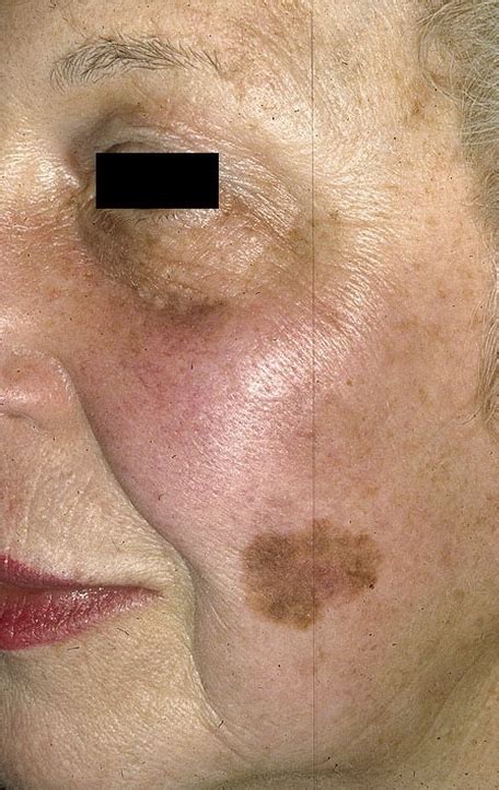 Basal Cell Carcinoma Cancer Lumps Under Skin Johns Hopkins Surgeons