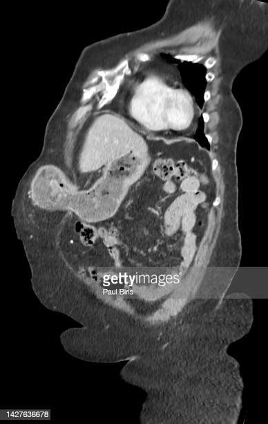 Umbilical Cord Hernia Imagens E Fotografias De Stock Getty Images