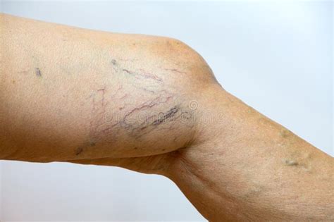 Varicose Veins On A Leg In Senior Women Close Up And Macro Shot