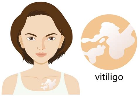 Vitiligo O Que é Causas Sintomas E Tratamento Centro Médico Cadeg