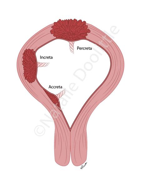 Learn vocabulary, terms and more with flashcards, games and other study tools. placenta accreta | Women's business | Pinterest | Placenta ...
