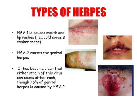 Below, we'll explain how these two types of the. Natural Treatment of Herpes - Blog