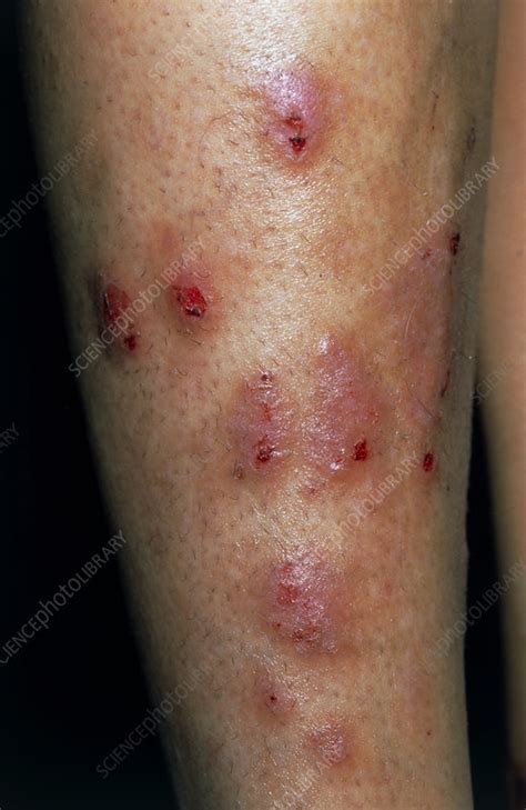 skin rash on legs