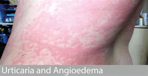 Urticaria And Angioedema Allergy Doctor Dr David Orton