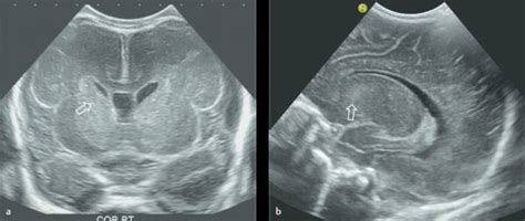3 Neonatal Cranial Ultrasonography Radiology Key
