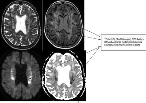 Hypoxic Ischaemic Brain Injury Practical Neurology