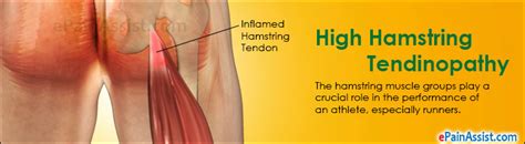 High Hamstring Tendinopathy Treatment Exercises Causes