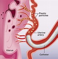Uterine Artery Embolization FAQs - Sydney Fibroid Clinic