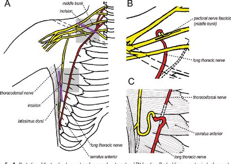 Figure From Two Level Motor Nerve Transfer For The Treatment Of Long Thoracic Nerve Palsy
