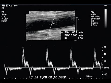 Upper Extremity Arterial Doppler Study UEA Practical Protocol YouTube
