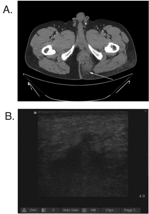 us and ct of patient with perirectal abscess figure a demonstrates download scientific