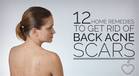 12 Home Remedies To Get Rid Of Back Acne Scars There Are Many Looking