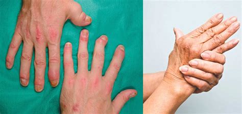 Find The Guttate Psoriasis Symptoms And Signs And Treatment Of