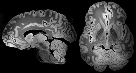 Mri Captures The Most Detailed View Yet Of A Whole Human Brain